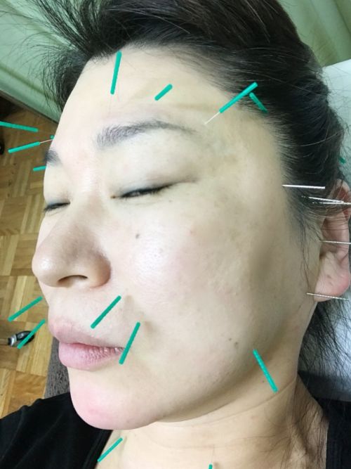 休日の美容健康法 美容針で小顔に 今年もあと2日 ヴォーグは明日までです 秋の訪れ Vogue Blog 小川町の美容室から施術の内容や無添加商品内容をブログで掲載しています